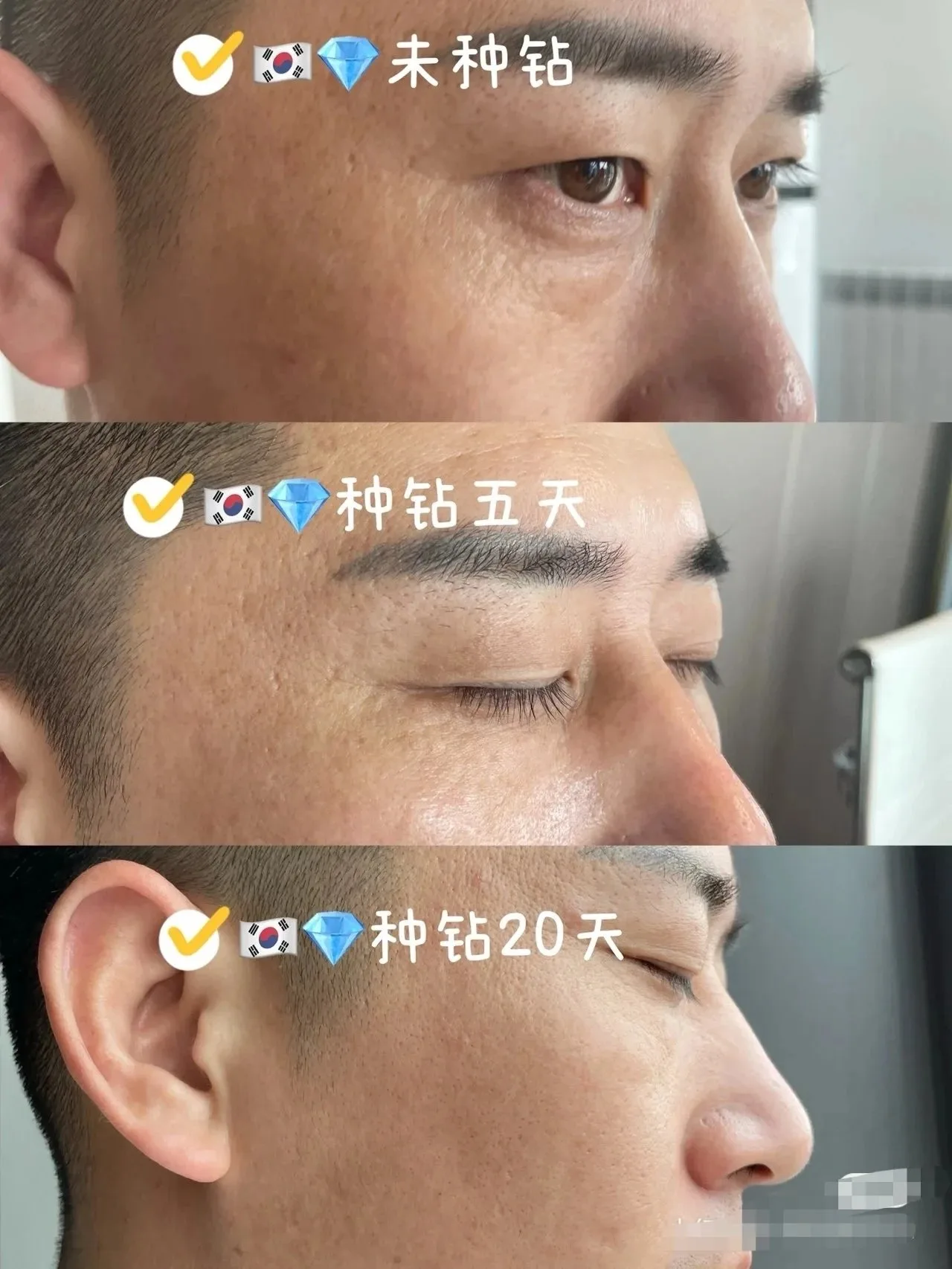 美修加海绵舒透焕颜管理套（金色12次装），海绵骨针12次装，升级款 图片 12