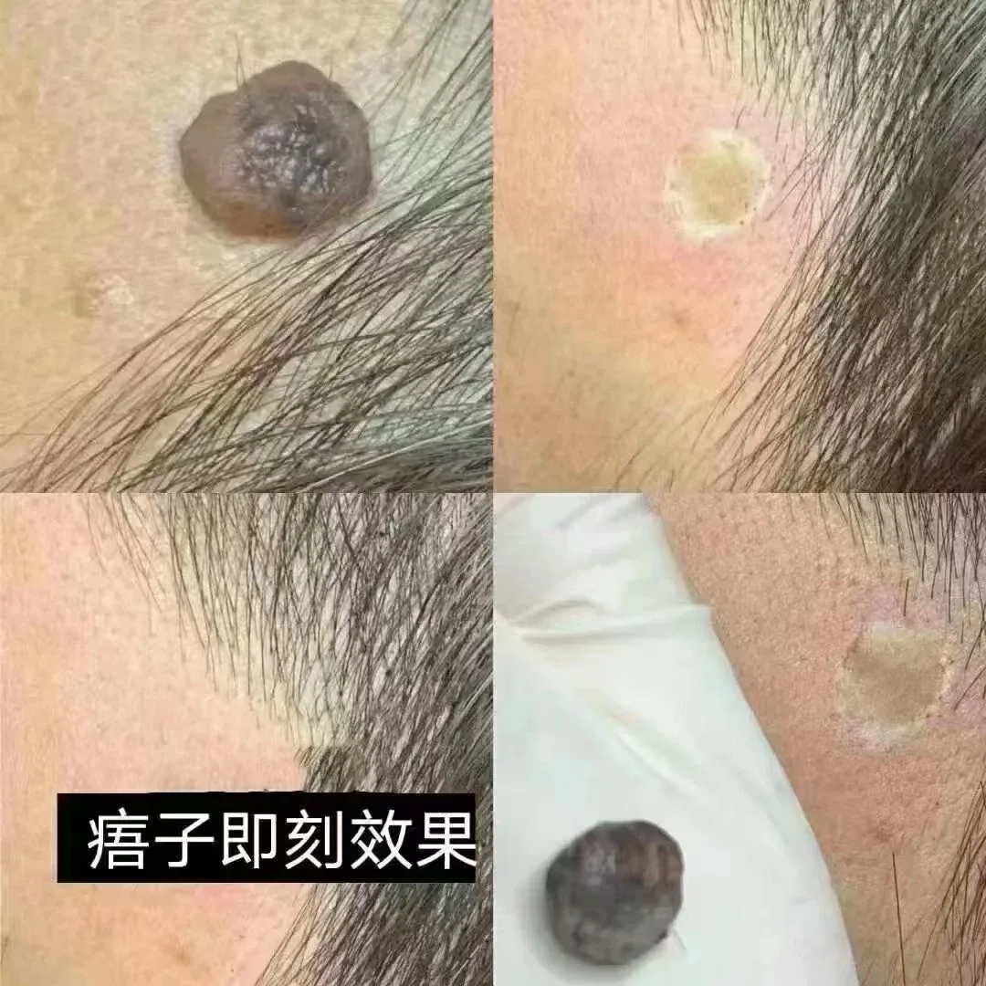点痣绝斑疫苗组合套盒，点痣，祛斑，祛斑，点疣 图片 9