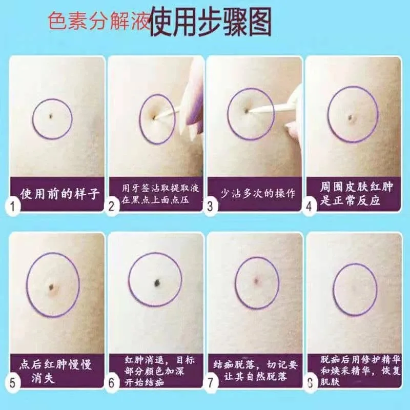 点痣绝斑疫苗组合套盒，点痣，祛斑，祛斑，点疣 图片 7