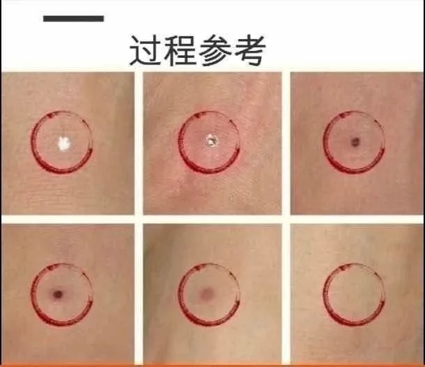 点痣绝斑疫苗组合套盒，点痣，祛斑，祛斑，点疣 图片 8