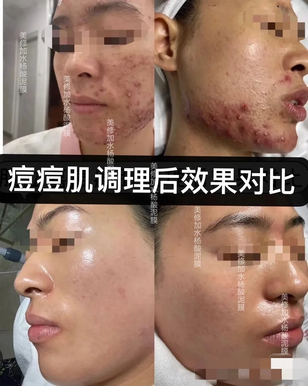美修加水杨酸净颜呵护泥膜，祛痘泥膜 图片 9