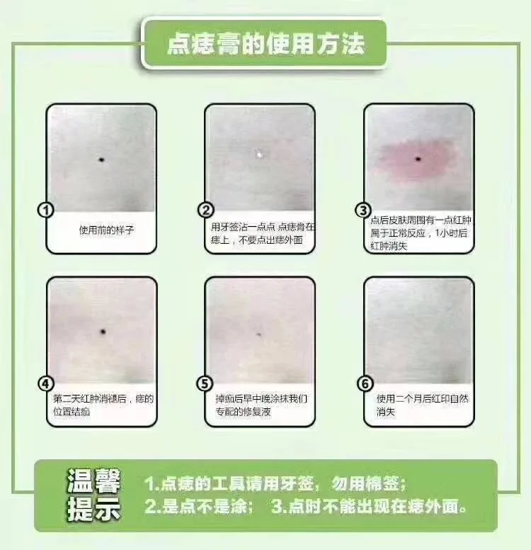 点痣绝斑疫苗组合套盒，点痣，祛斑，祛斑，点疣 图片 6