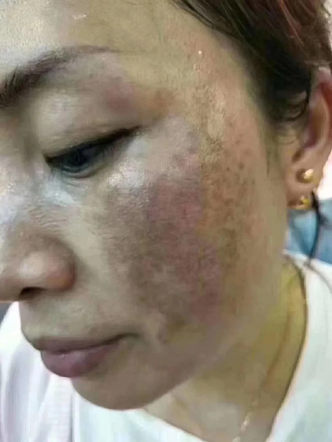 祛斑，真皮斑组断因子升级款 图片 15