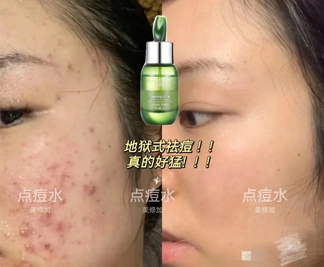 美修加净颜修肤冻干液，点痘水祛痘水 图片 12