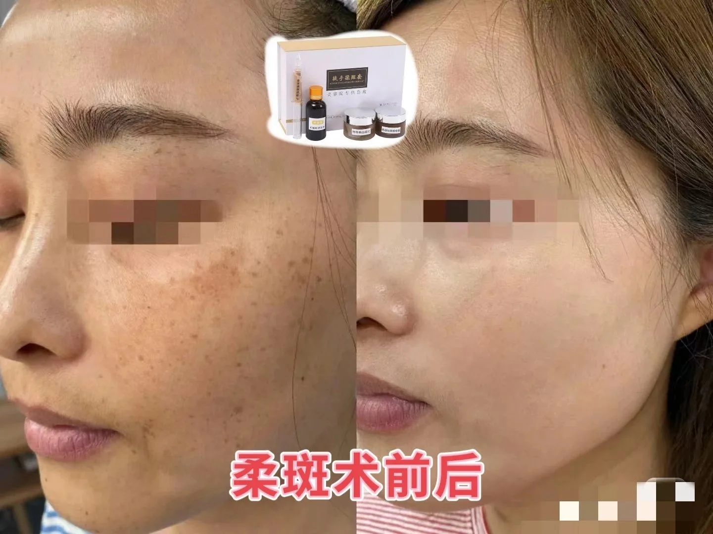 徒手揉斑术B款包装四件套 图片 9