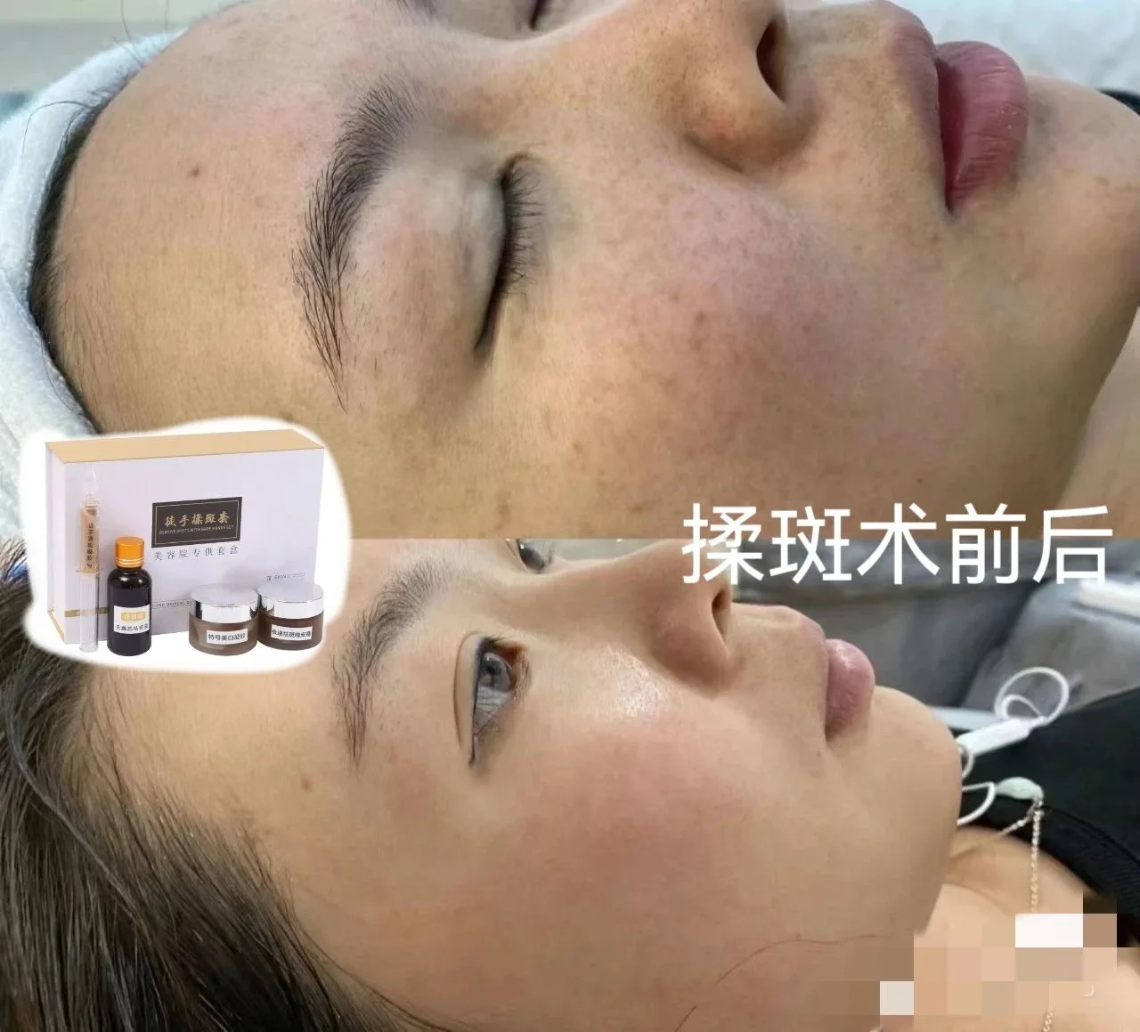 徒手揉斑术B款包装四件套 图片 8
